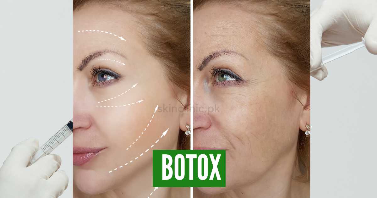 botox face before and after